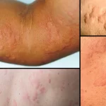 Surprising Causes Of Hives Revealed — What May Be Triggering Your Skin Reaction 1800x1200_hives_and_your_skin_bigbead