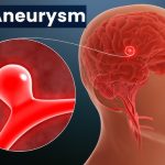 12 signs that may signal a brain aneurysm — Don’t ignore them hq720